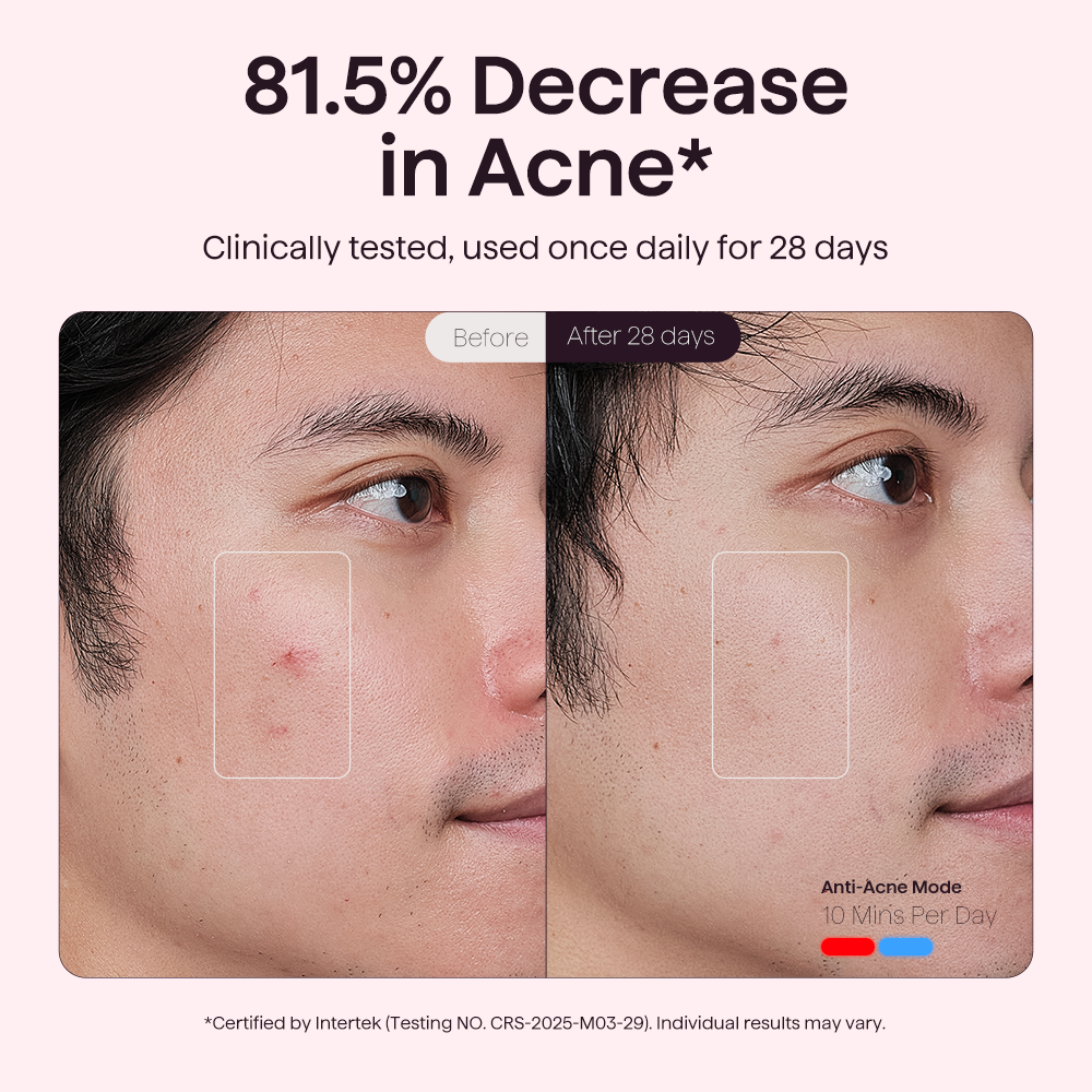 Before and after comparison of acne reduction on a person's face with text indicating 81.5% decrease in acne.